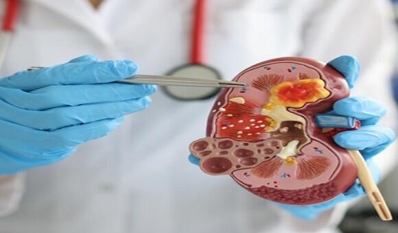 Reasons behind kidney stones - Dr.Jaspreet singh sandhu