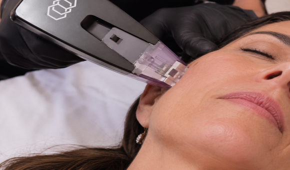 Can Morpheus8 for Wrinkles Be Combined With Botox?